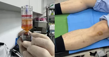 stem cell facial injections